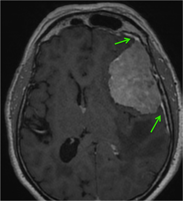 Las flechas verdes indican engrosamiento y realce de la duramadre adyacente a la lesión.