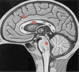 Localizaciones de la LAD.