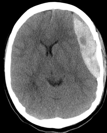 Hematoma epidural con remolino de sangrado agudo.