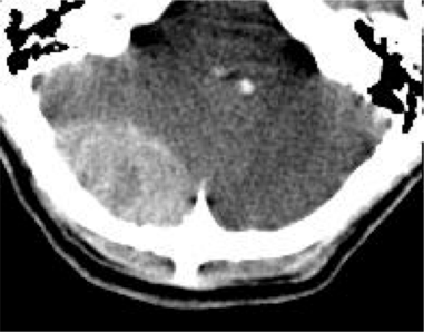 Hematoma Epidural de origen venoso. Se 