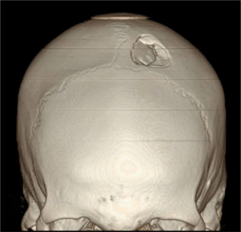Fractura con hundimiento.