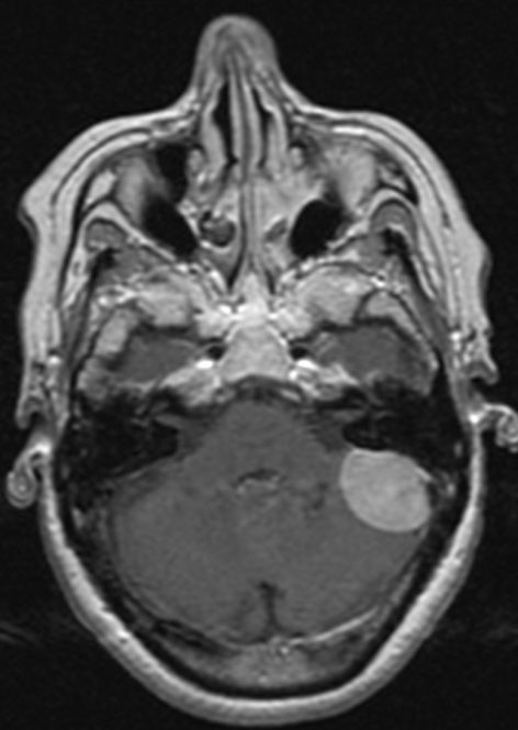 Menignioma en Fosa Posterior cercano al angulo pontocerebeloso. 