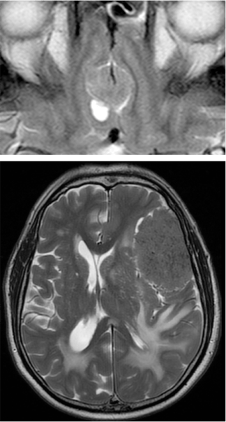 Halo periferico LCR hiperintenso en T2.