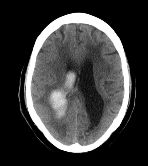 Hematoma parietal con rotura del ependimo y extensión hacial el ventrículo derecho. Observa la pérdida de surcos en la convexidad por edem asociado con respecto al lado contralateral.     Hematoma parietal con rotura del ependimo y extensión hacial el ventrículo derecho. Observar la hidrocefalia obstructiva que está produciendo con edema transependimario y la pérdida de surcos en la convexidad por edem asociado con respecto al lado contralateral.