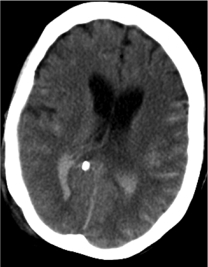 HSA con hemorragia intraventricular.