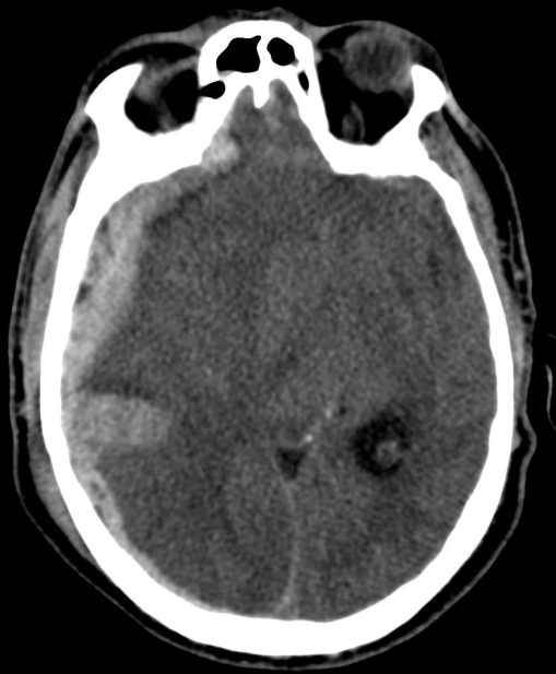 Hematoma subdural en la convexidad derecha. Asocia un foco contusivo hemorrágico rodeado por halo hipodenso de edema.