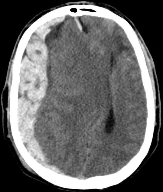Semiluna hiperdensa en la convexidad derecha con focos hipodenso en su interior que indica sangrado activo.