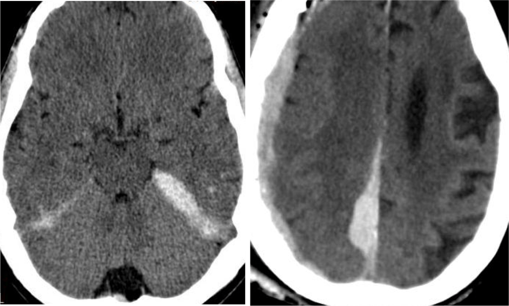 Se observa sandrado subdural en la hoz del cerebro y tentorio.