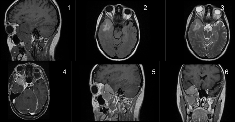 Meningioma en placa de localización en lóbulo temporal. 1)