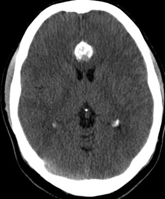 menigioma calcificado