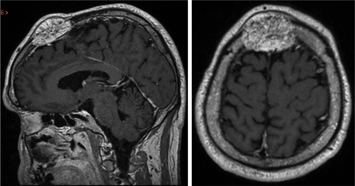 meningioma óseo.png