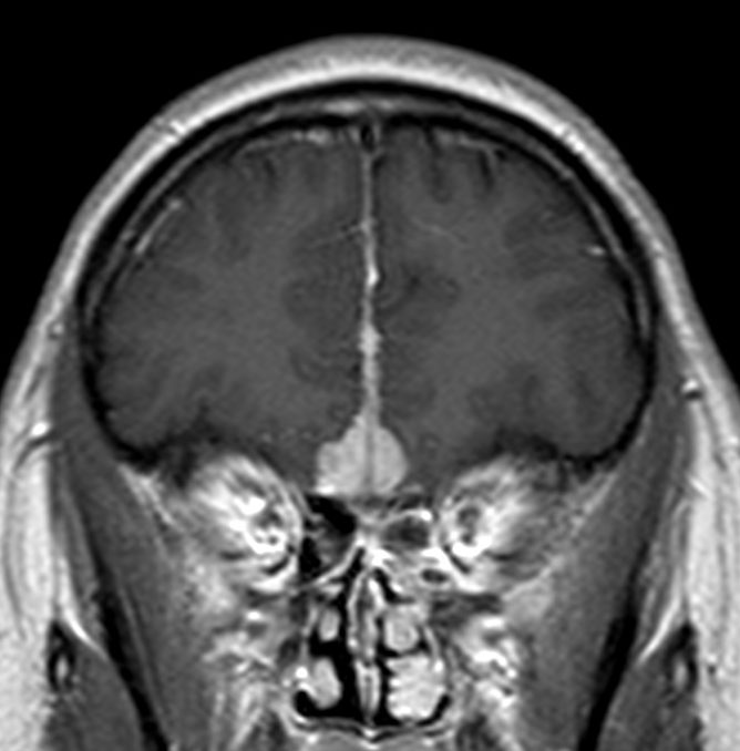 Menignioma frontal en la linea media con engrosamiento dural.