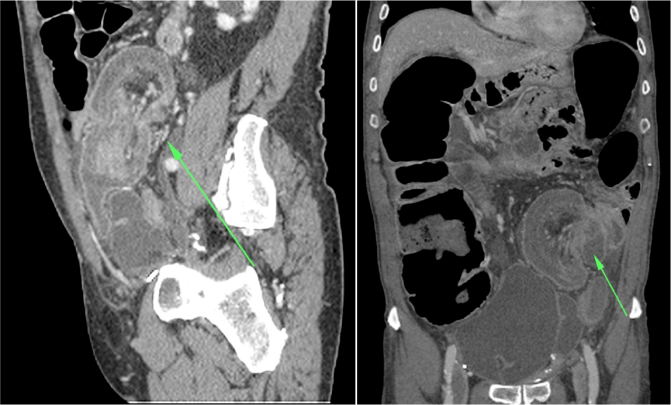 Reconstrucciones coronal y sagital.