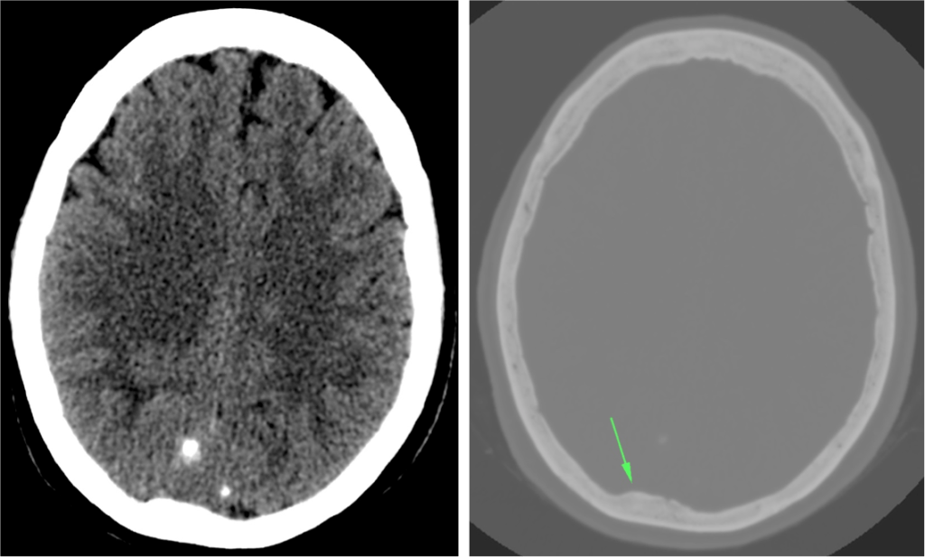 Se observan unas calcificaciones occipitales. La masa es isodensa con respecto al parénquima adyacente y practicamente no se diferncia con claridad. Sin embargo, al poner la ventan de hueso se observa una hiperostosis del hueso adyacente. 