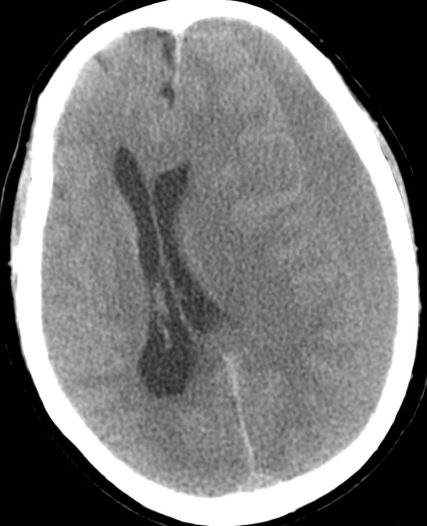 Subdural cronico isodenso