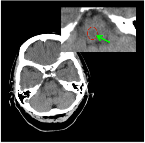 Foco contusivo en protuberancia