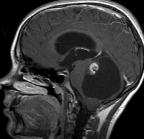 Astrocitoma pilocitico en paciente pediátrico con herniacion amigadalar incipiente