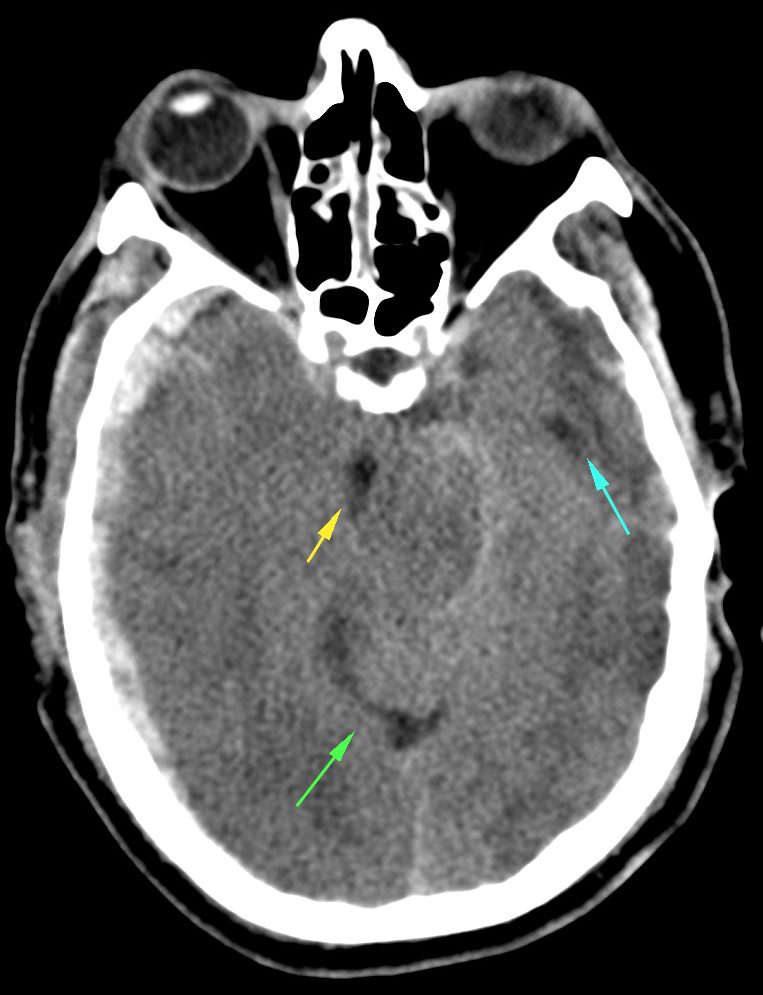 Hematoma subudural derecho con edema cerebral asociado que borra surcos y comprime el asta temporal ipsilateral (no se ve). Existe dilatación del asta temporal contralateral (flecha azul), dilatación de