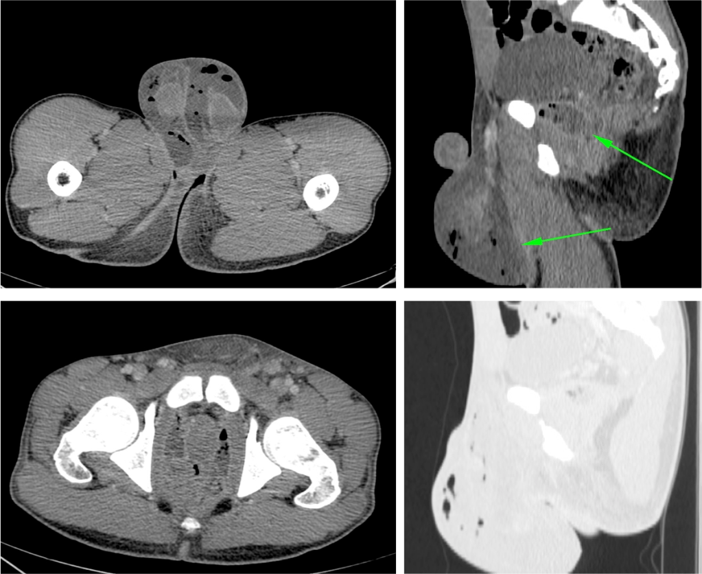 Mismo paciente que en la fotografia anteriormente expuestas. Cambios inflamatorios y signos de enfisema de la piel del escroto con 