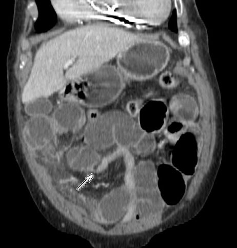 Reconstruccion coronal donde se observa claramente un cambio de calibre en asas de delgado, debido a adherencia postquirúgica.