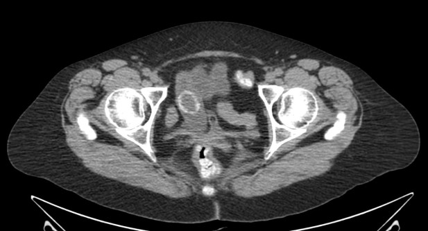 En íleon terminal se identifica una imagen redondeada y bien definida, con alta densidad cálcica peiférica, la cual es compatible con una litiasis biliar impactada.