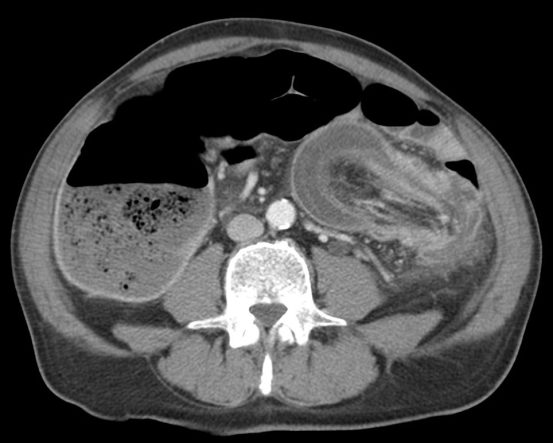 Se observa un segmento mayor de 4 cm del colon descendente que se introduce telescópicamente en un segmento más distal del propio colon, arrastrando mesenterio y vasos consigo, los cuales pueden terminar estrangulándose y provocando isquemia. Observar la distensión retrógrada muy marcada del ciego y colon ascendente con asas de delgado normales (no se muestra), signos que indican obstrucción intestinal con válvula ileocecal competente.
