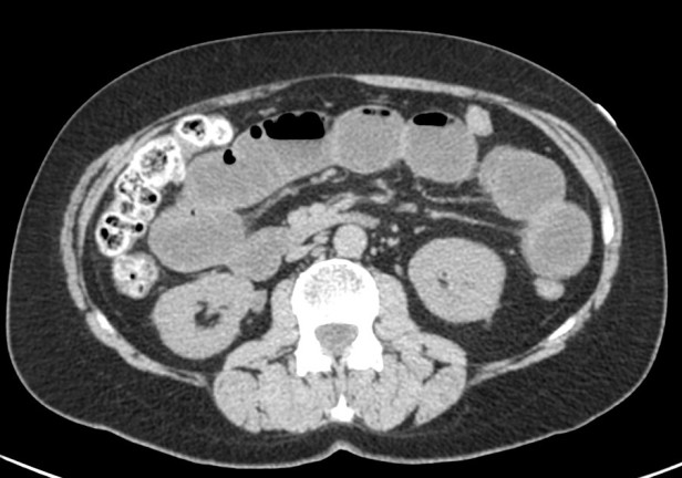 Se observa marcada distensión de asas de delgado con contenido líquido en su interior.