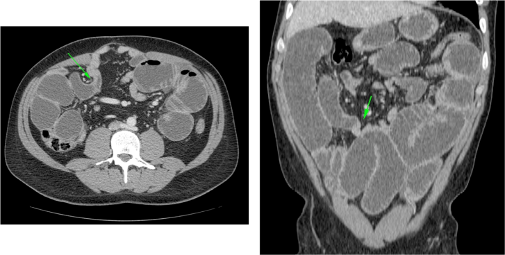 Cambios de calibre en asas de ilieon sin causas aparentes en paciente con antecedentes quirúrgicos.