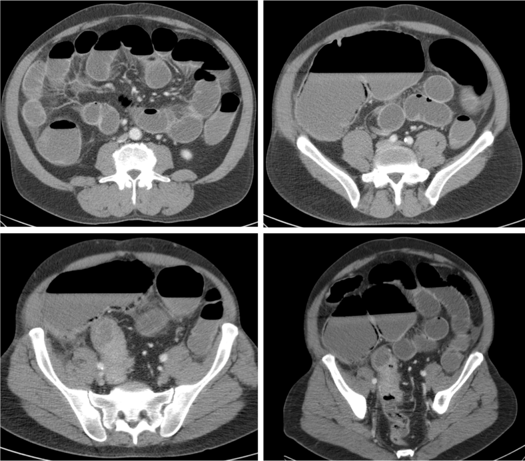 Se observa una masa en el sigma de ocluye el lumen y produce dilatación retrógrada de todo el colon las asas de delgada por incompetencia de la válvula ileocecal. Notese la gran distensión del colon ascendente y ciego con signos de neumatosis intestinal, hallazgos compatibles con isquemia.