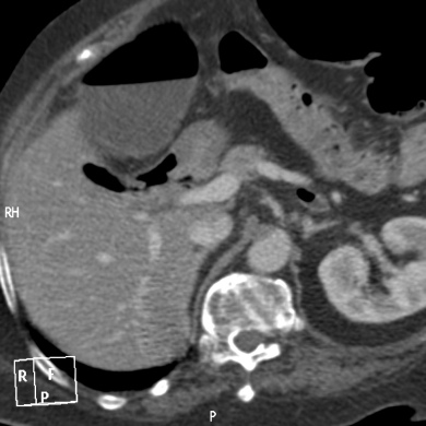 Se observa la vesícula repleta de aire con una fístula que comunica con duodeno.