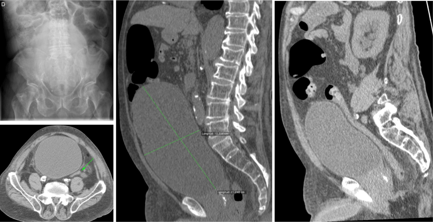 Globo vesical. En la radiografia de abdomen se observa imagen compatible con una masa que desplaza las asas intestinales hacia la periferia. La imagne TC axial evidencia que se trata de la vejiga, la cual está comprimiendo el colon descendente. Observar en las reconstrucciones sagitales el tamaño de la vesicula y el colapso de la luz de colon descendente, motivo por el cual el paciente presentaba una clinica oclusiva (dolor, esternimiento, distensión abdominal).