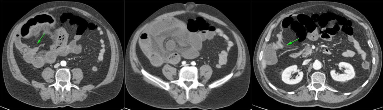 Hernia interna probablemente pericecal, con despalzamiento del ciego y dialtación de asas de ileon. Las flechas señalan los cambios de calibre en el asa aferente y eferente.