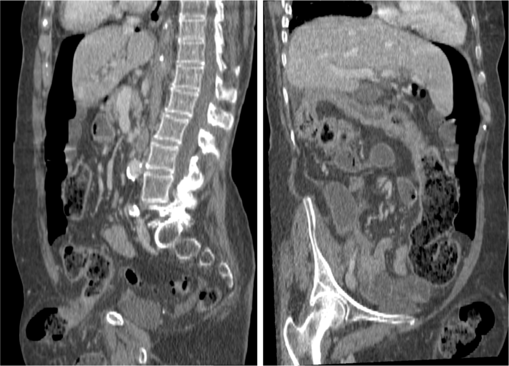 Hernia inguinal izda con signos de isquemia retrograda del colon. Obsersvar que se prouduce engrosamiento mural del colon con aumento de realce, afectación de la grasa mesenterica y perferoación (neumoperitoneo moderado).