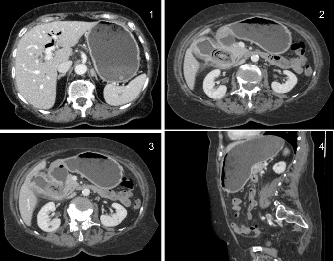 1) Neumobilia + Dilatación de la cámara gástrica 2) Litiasis bilar + vesícula con proceso inflamatorio 3) Fístula vesiculo entérica 4) Dilatación de la cámara gástrica por obstrucción.