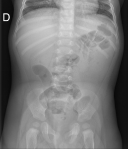No indicada para el diagnostico. Ausencia de aire en ciego/colon ascendente y Dilatación de asas de delgado.