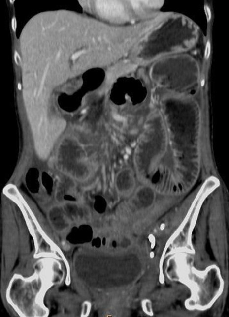 Reconstrucción coronal con técnica MIP que muestra engrosamiento parietal y estenosis irregular de un segmento de colon descendente-sigma. Dilatación de asas proximales. Cañete Moslero et al.