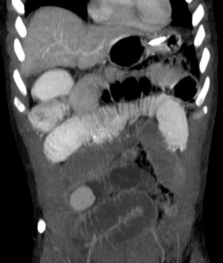 Reconstrucción coronal con técnica MIP que muestra un cuerpo extraño de alta densidad en asas de íleon con dilatación de asas proximales y colapso de íleon distal. Tras deterioro clínico del paciente se realizó laparotomía exploratoria con extracción de los dos cuerpos extraños. Cañete Moslero et al.