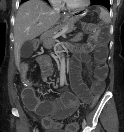 TC de abdomen con contraste iv en fase portal: Reconstrucción coronal-oblicua con técnica MIP de donde se observa dilatación de asas de intestino delgado proximales a la anastomosis ileocólica, con estenosis de un segmento de íleon previo a la misma. Se resolvió con tratamiento conservador. Cañete Moslero et al.