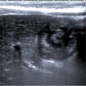 Imágen en forma de “Donut”: masa con líneas hiper e hipecogénicas alternándose