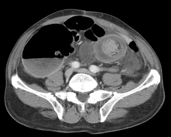 Se observa una imagen que puede simular una diana. En el centro se observa una lesión subyacente que actua como cabeza o punto guía de la invaginación. Dicha lesión se sospechaba que se de una neoplasia. Sin embargo, el análisis anatomopatológico de una muestra de unos 20 cm no desmostro lesión secundaria subyacente, solamente intususpección con signos de isquemia.