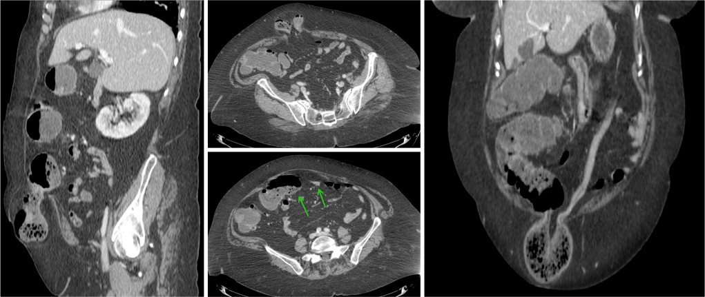 Hernia inguinal dcha con asas de colon en el saco herniario. Observan en los cortes axiales (flechas verdes) el cambio de calibre. La imagen de la izquierda es una reconstrucción coronal donde se aprecia claramente un punto de cambio de diamtero de asas con marcado colapso distal del resto de asas colónicas.