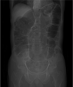 Se observa el sigma con una diltación desproporcionada y produciendo una imagen en grano de café. Se sitúa en posición anormal y llega a ascender por encima del colon transverso