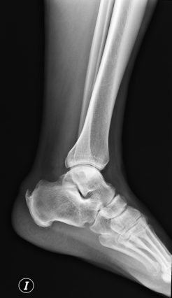 Deformida ósea en calcáneo.